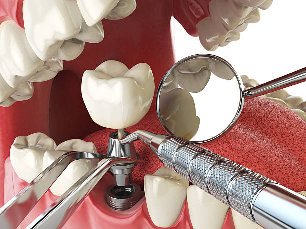 Best Chipped Tooth Repair Near Me  in Watertown, MN